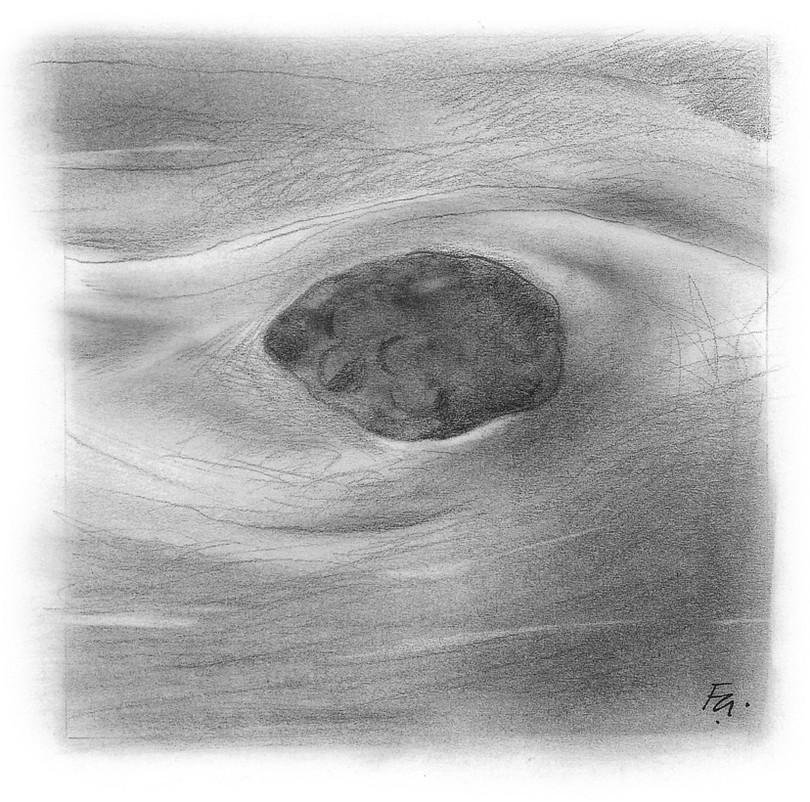 Figure 1-8: The nodular appearance of a fibroadenoma. Benign lumps (such as fibroadenomas) lie within normal breast tissue.