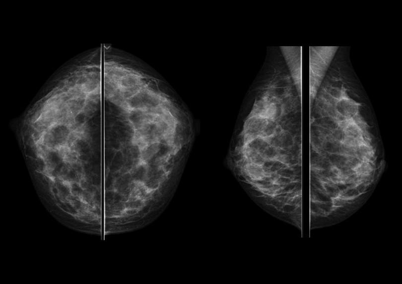 Figure 3-1: Normal breasts shown on a mammogram. Ducts and glandular tissue appear whitish while fat appears black.