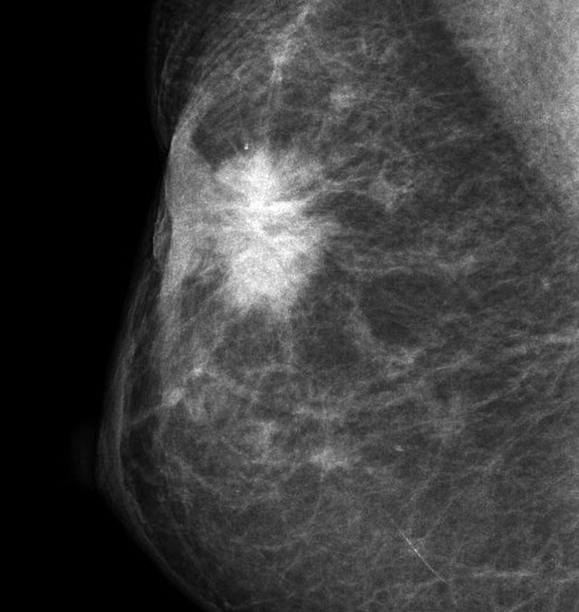 Figure 3-2: The cancer appears white and irregular (spiculated) against the black background.
