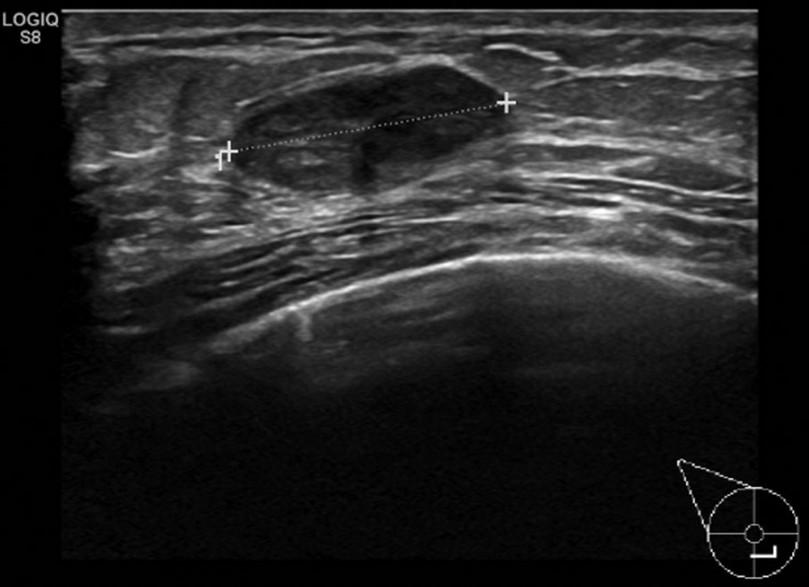 Figure 3-6: The appearance of a fibroadenoma on an ultrasound scan. It typically has clear margins and compresses the tissue around it. Note nodular appearance.