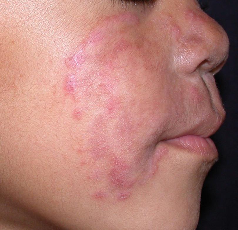 Ringworm