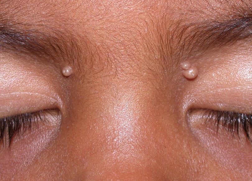 Molluscum contagiosum