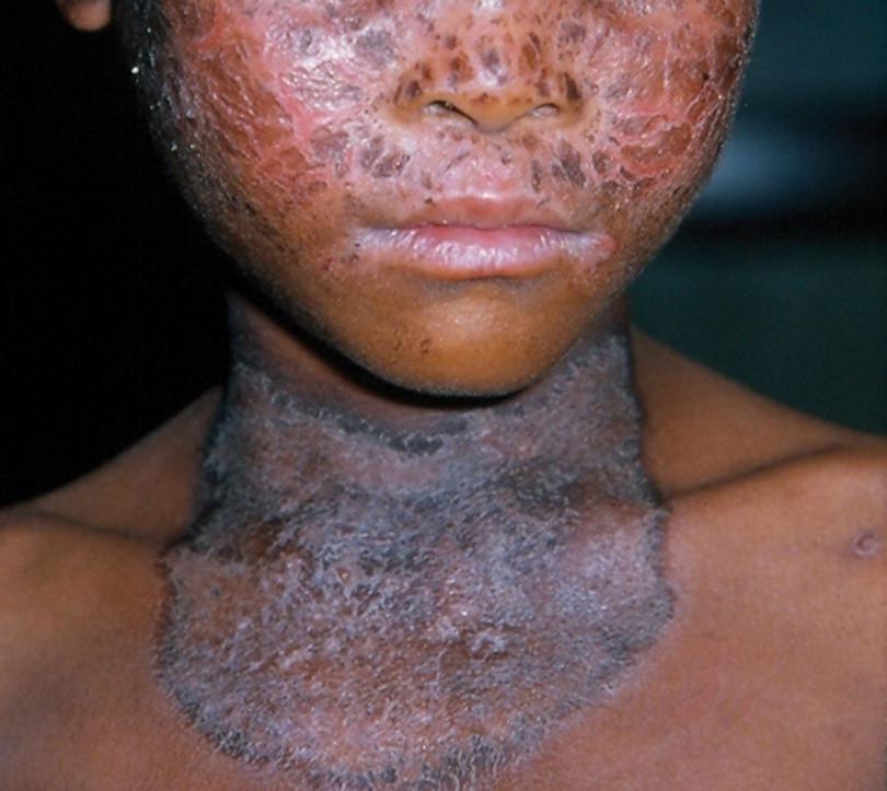 Pellagra rash