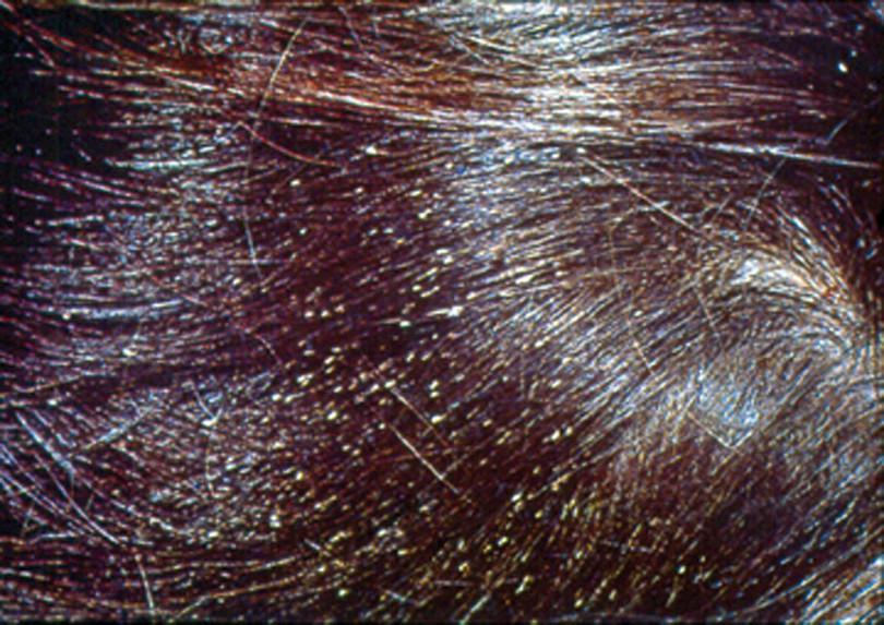 Lice