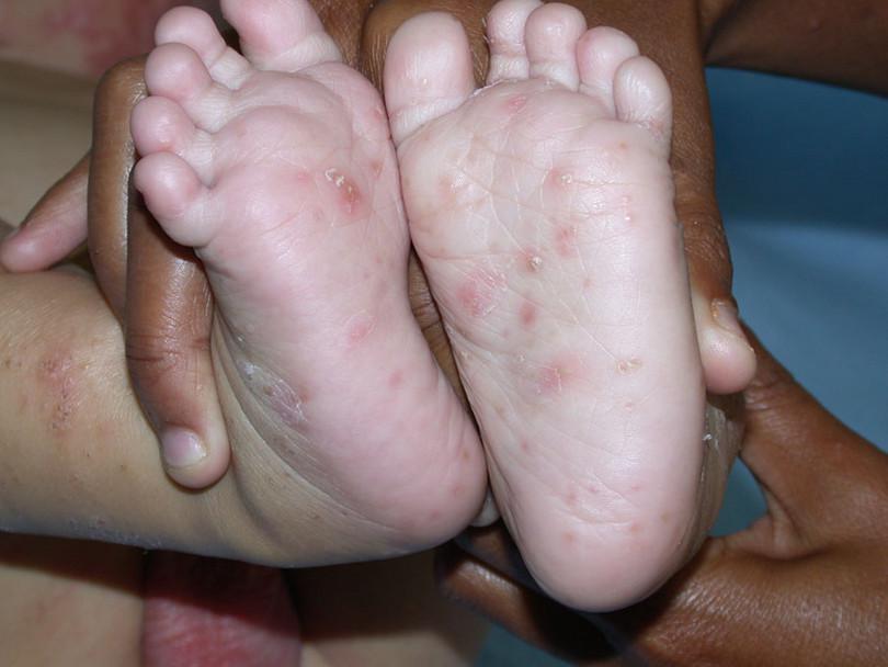 Scabies