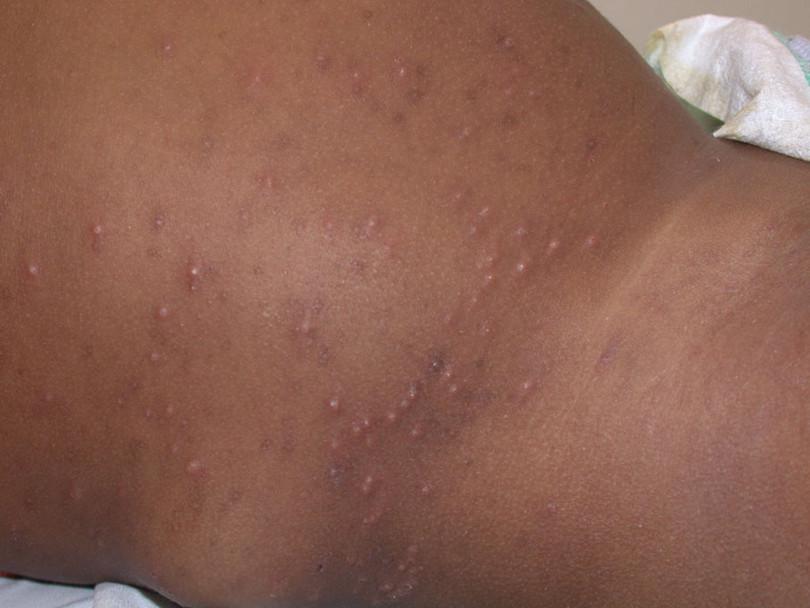 Papular urticaria