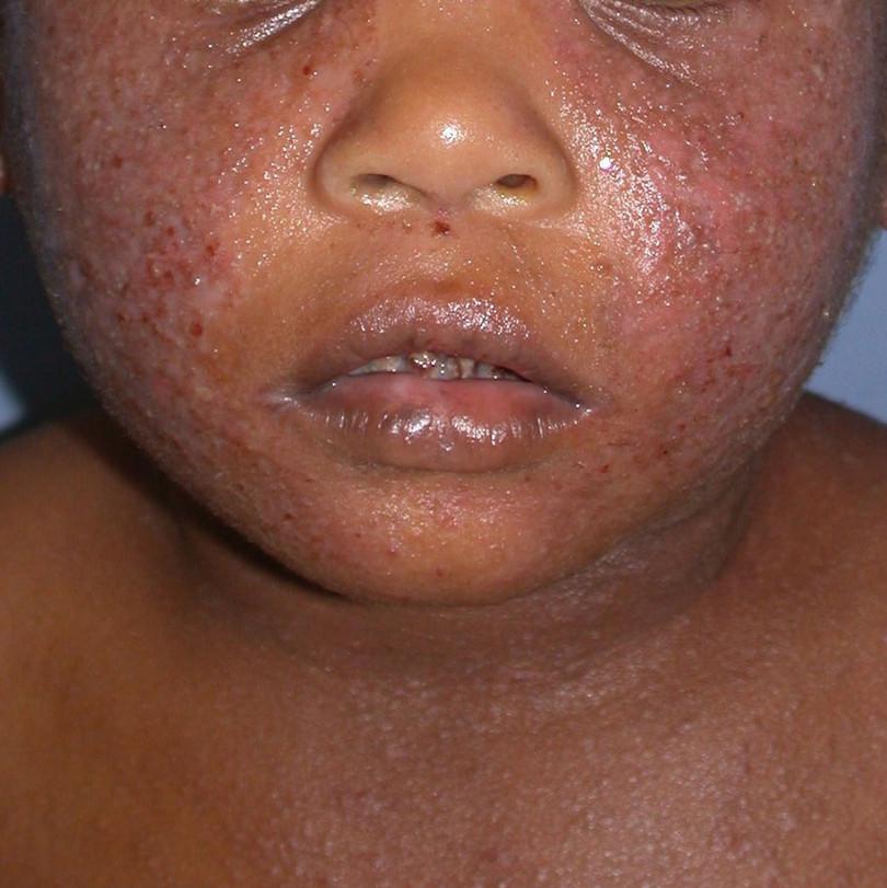 Acute eczema