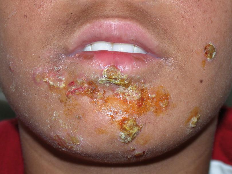 Impetigo