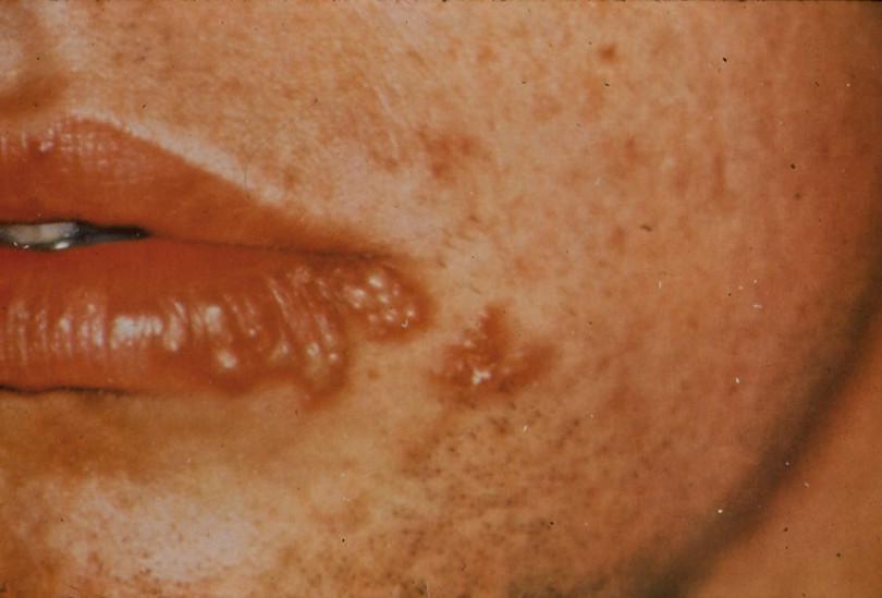 Herpes simplex