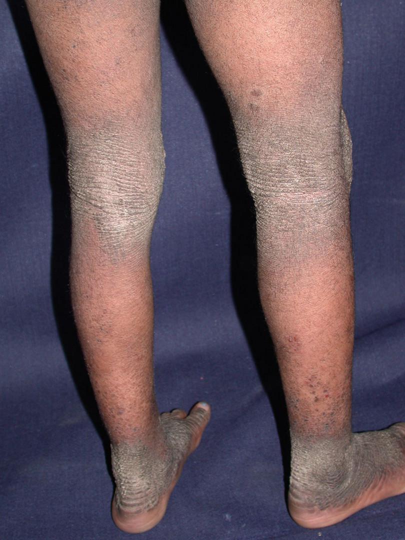 Chronic eczema
