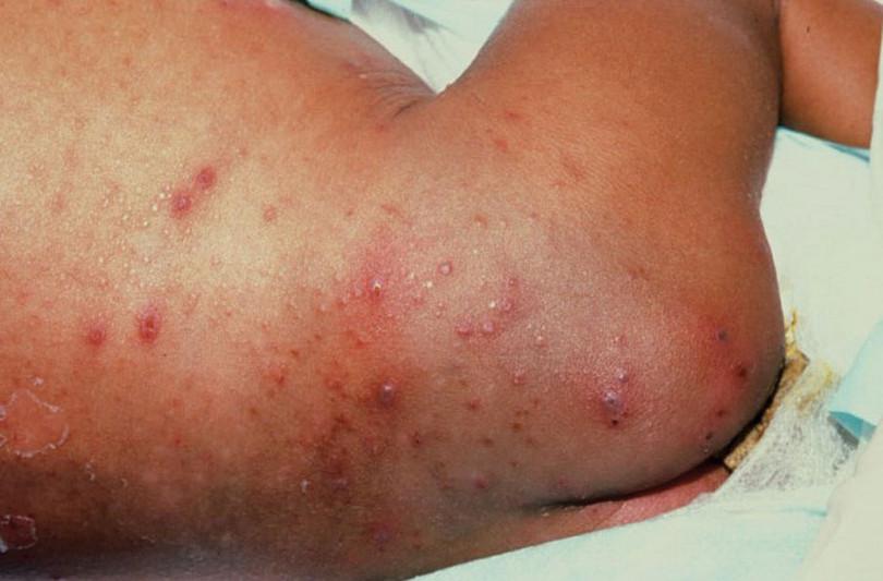 Chicken pox