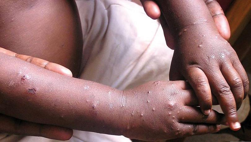 HIV rash