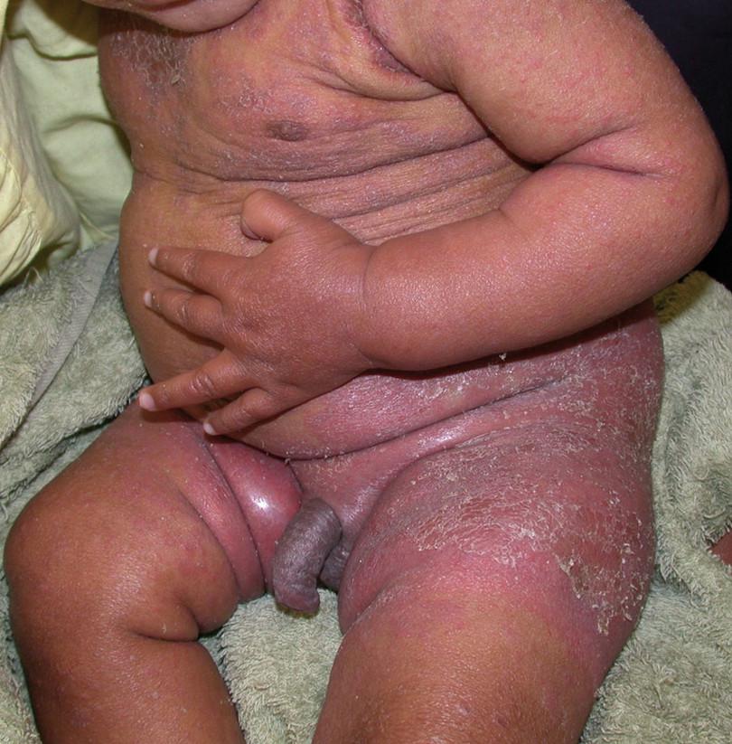 Seborrhoeic dermatitis