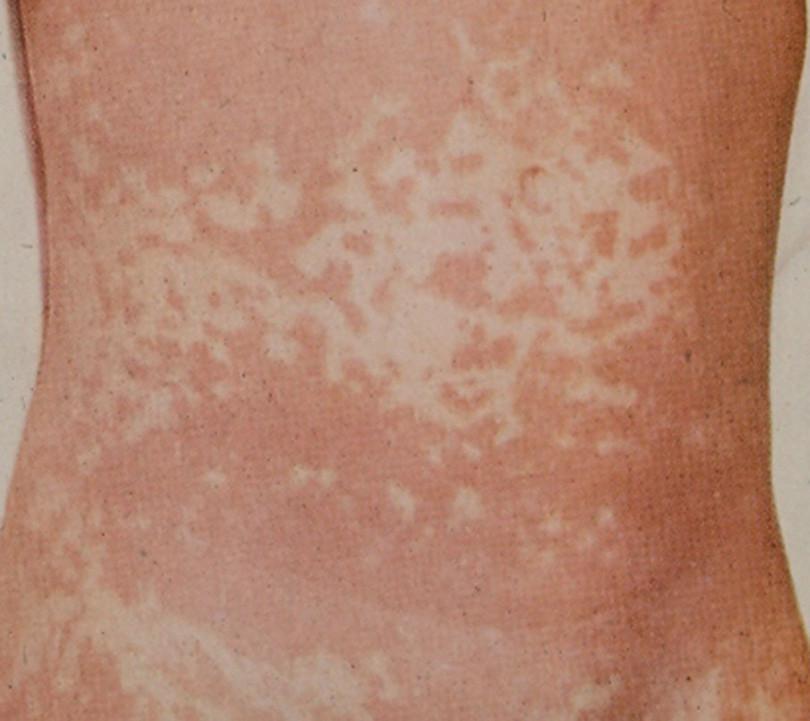 Measles