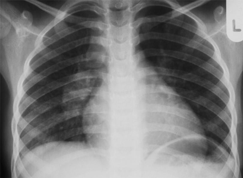 Figure 1: Enlarged hilar lymph nodes on the right hand side. The lungs appear normal. This is the commonest form of childhood TB.