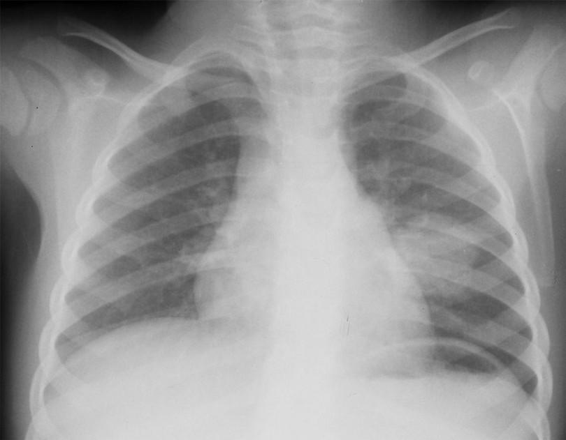 Figure 2: Primary TB infection of the left lower lobe