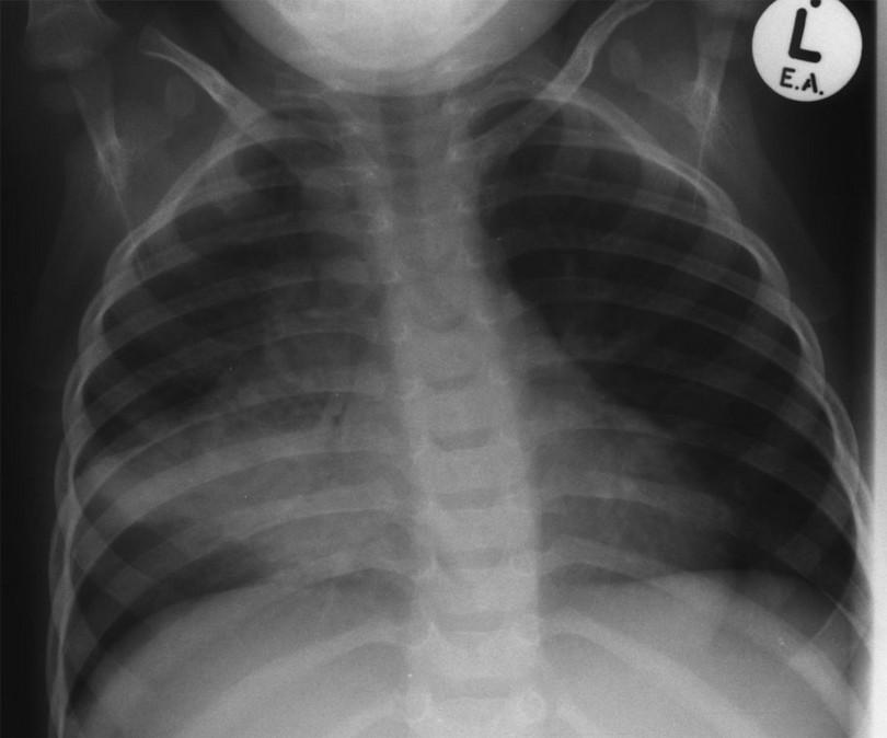 Figure 3: Enlarged hilar and paratracheal lymph nodes with TB pneumonia of the right middle lobe. On careful inspection narrowing of the right bronchus can be seen.