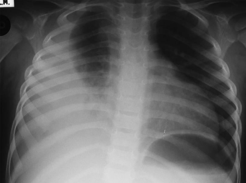 Figure 4: A large right sided pleural effusion seen in an older child