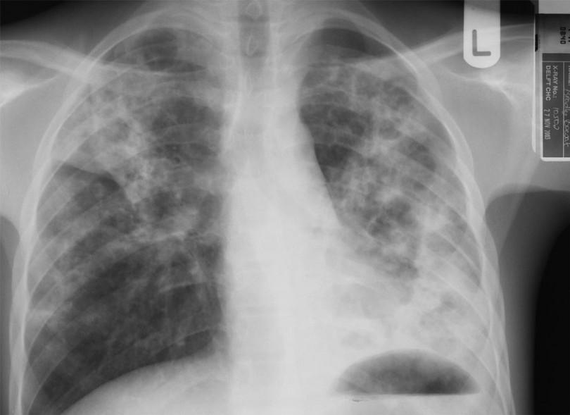 Figure 5: Severe TB in an adolescent with scattered areas of pneumonia and cavities in both upper lobes. This highly infectious form of TB is usually seen in adults.