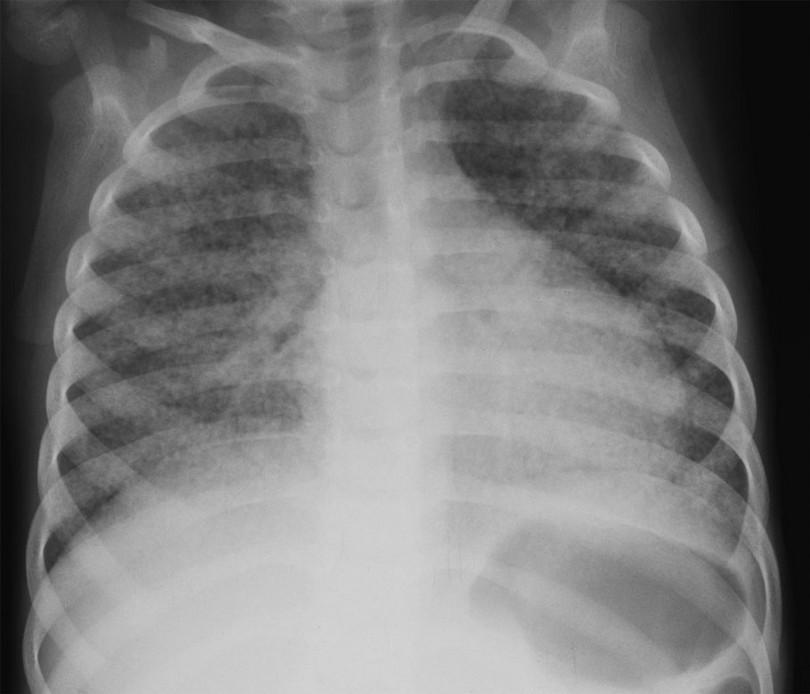 Figure 6: A typical example of miliary TB with fine nodules visible in all the lobes of both lungs.
