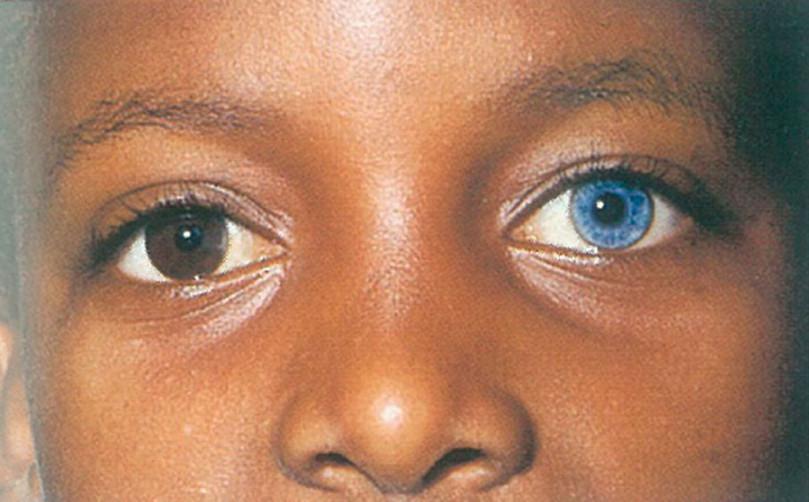 Heterochromia: Different-coloured eyes or blue eyes in dark skinned child