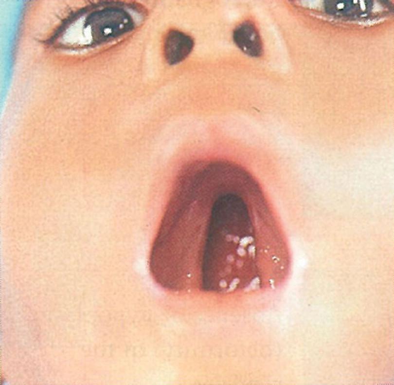Isolated cleft palate