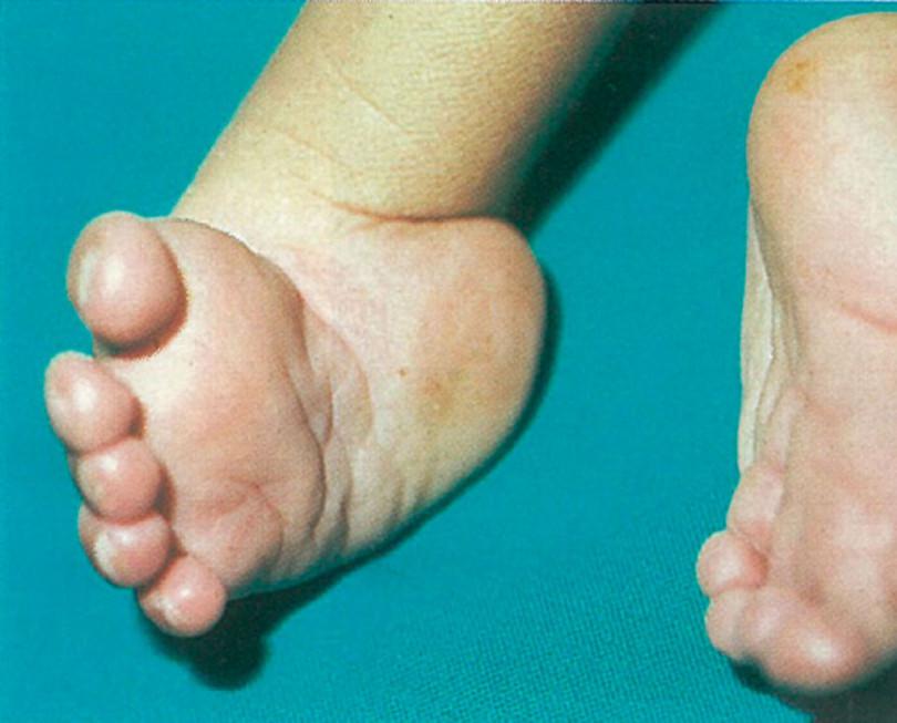 Club-foot