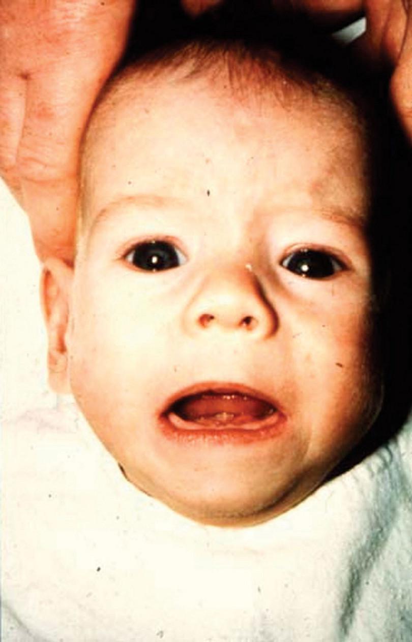 Infant with fetal alcohol syndrome: long smooth upper lip