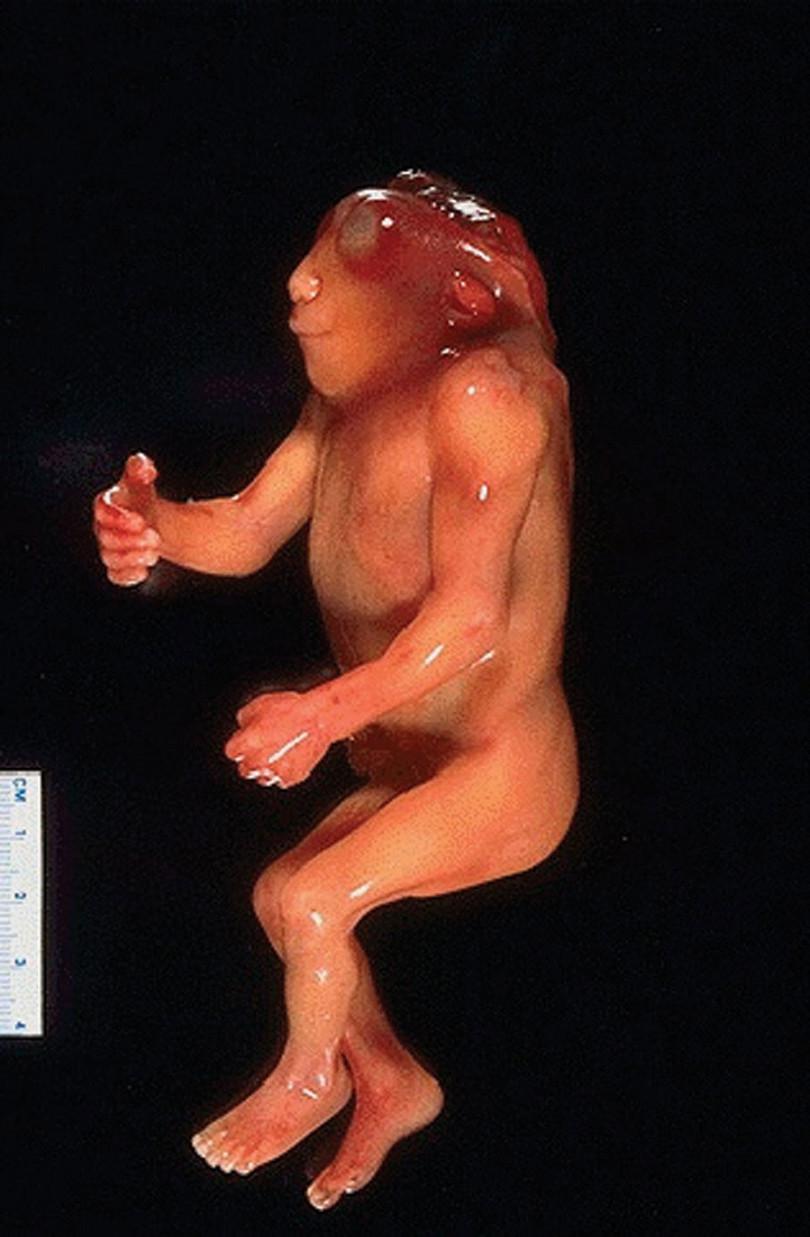 A fetus with anencephaly exposing the brain