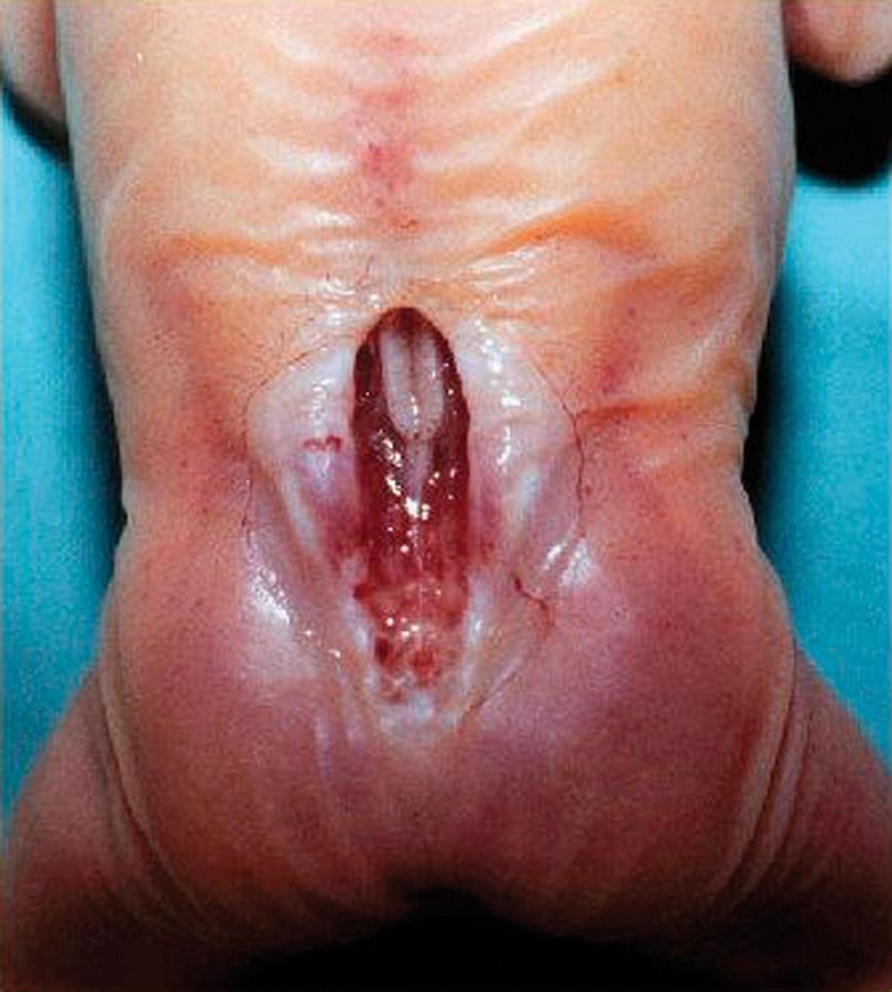 Severe lumbosacral meningomyelocoele with neural tissue exposed