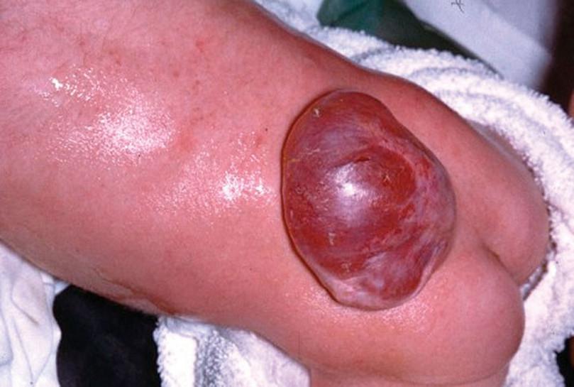 Severe meningomyelocoele with a thin membrane covering the defect