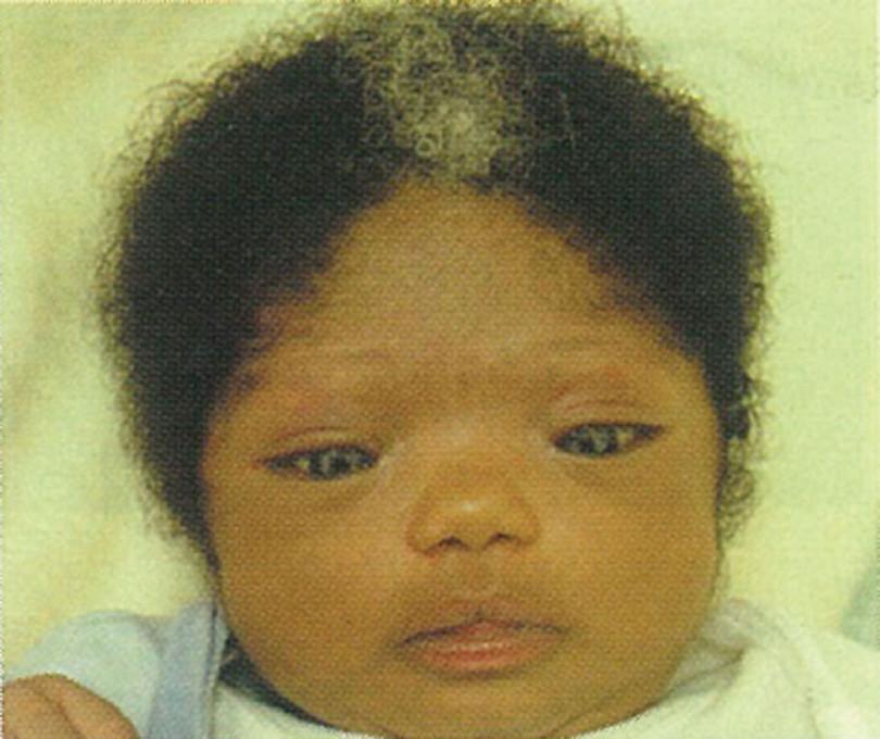 Waardenburg syndrome: An infant with a white tuft of hair and wide spaced eyes
