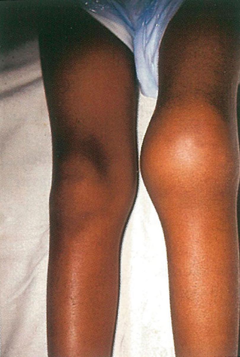 Haemophilia: A swollen knee due to bleeding into the joint
