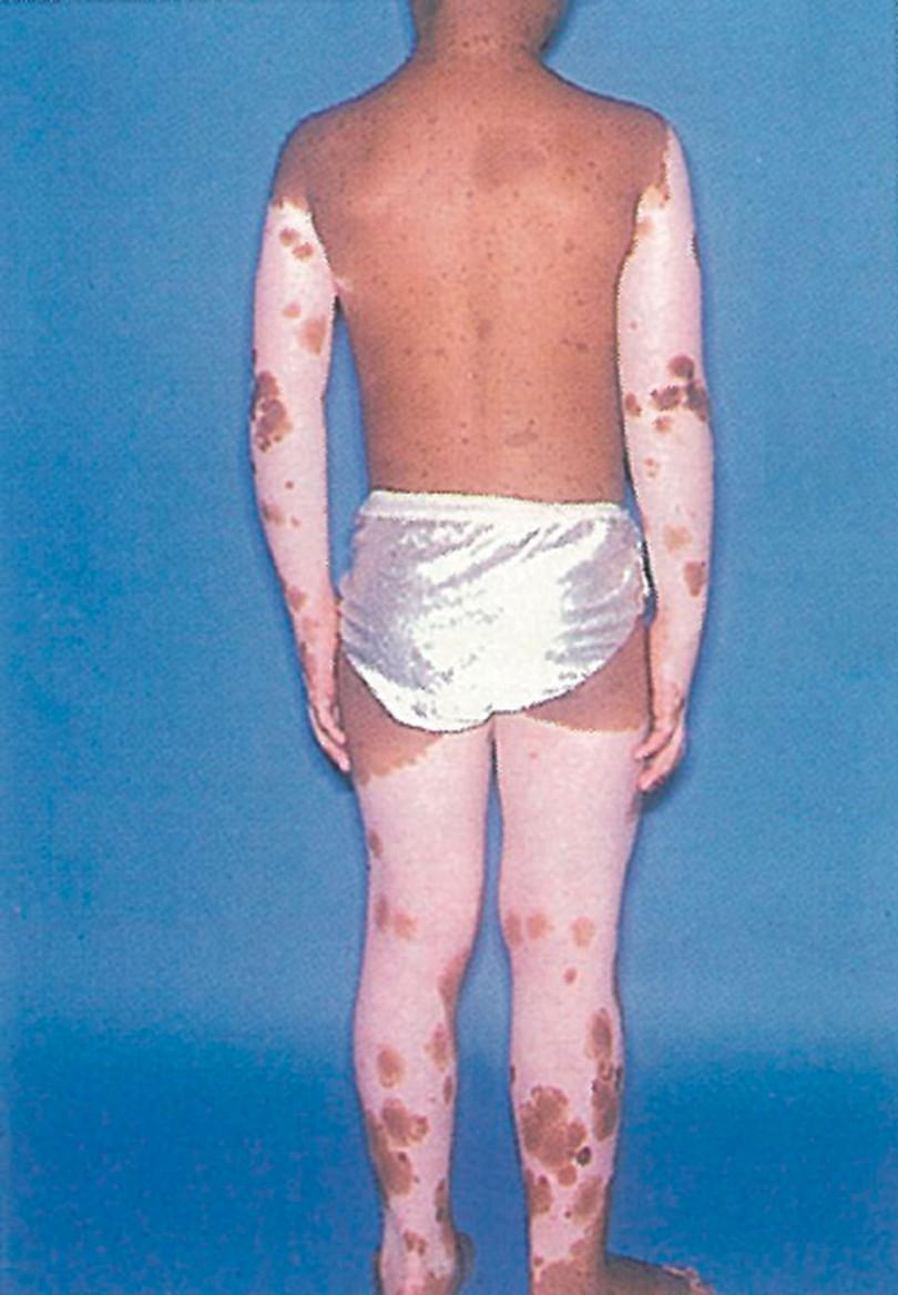 Vitiligo: decreased skin pigmentation