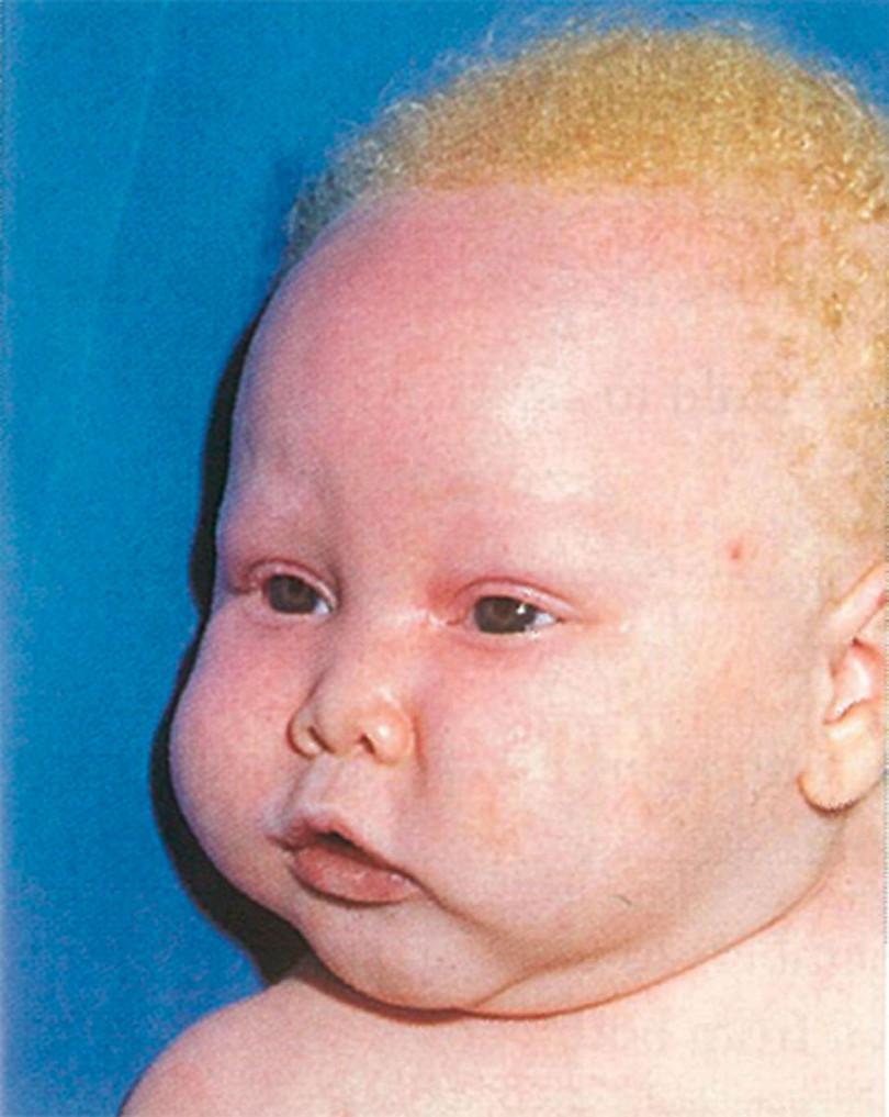 Oculocutaneous albinism