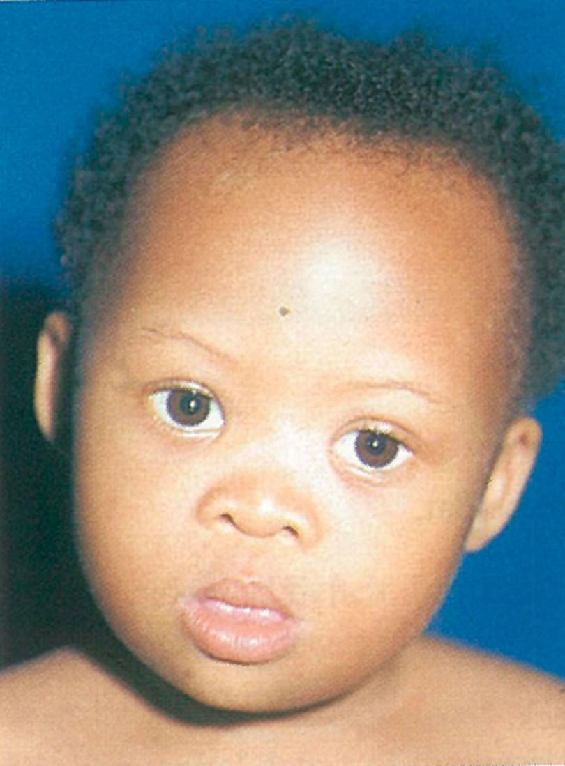 Down syndrome: The eyes slant upwards, the bridge of the nose is flat, and the tongue may protrude