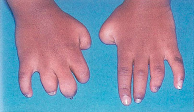 Amputated fingers in amniotic band syndrome