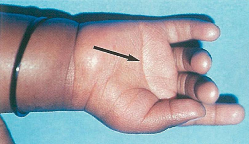 Single transverse palmar crease