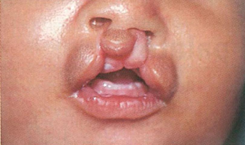 Bilateral cleft lip and palate